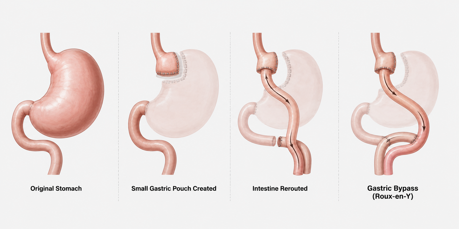 Gastric Bypass Surgery