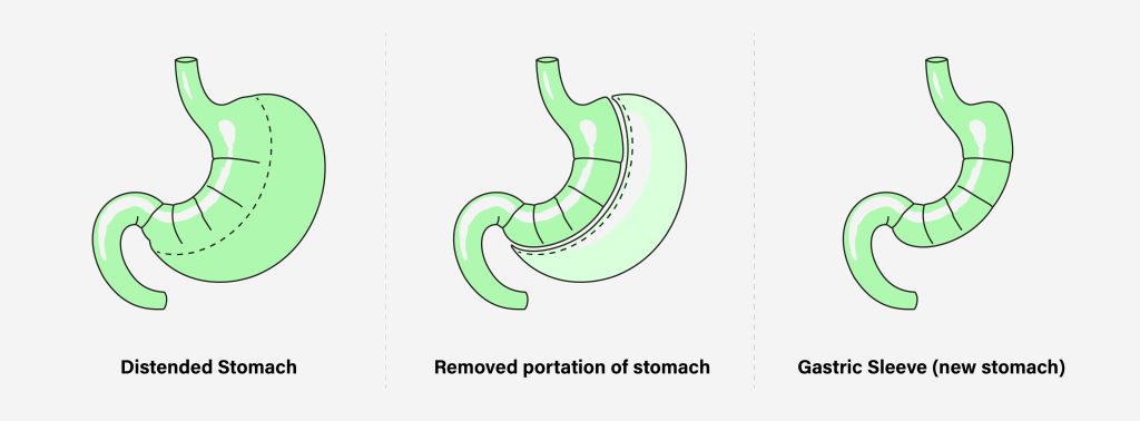 Gastric Sleeve Surgery